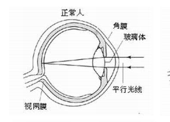 眼睛近视能治疗吗，近视眼恢复小妙招