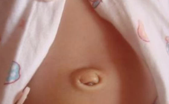 宝宝脐疝怎么护理？宝宝脐疝图片