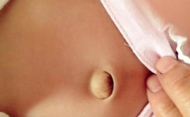 宝宝脐疝怎么护理？宝宝脐疝图片