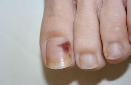 指甲变黑是怎么回事？手指甲变黑的几个原因