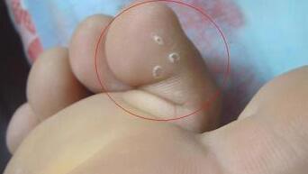 脚气的症状：脚气的症状有哪些表现