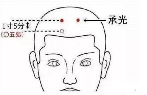 承光穴怎么找，承光的准确位置图片和作用