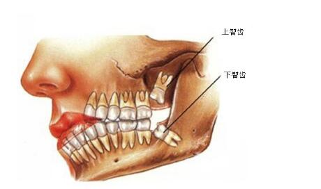 智齿一定要拔吗？拔个智齿需要多少钱？
