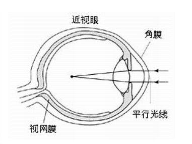 500度近视是几点几(五分制)？
