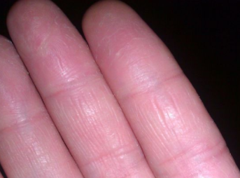 手脱皮是怎么回事,手指脱皮怎么办