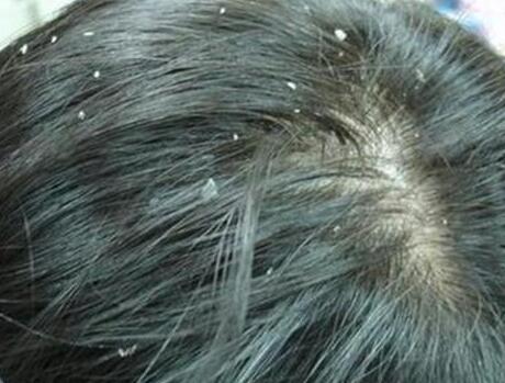 为什么会有头皮屑，什么原因引起头皮屑