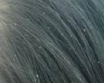 头上老有头皮屑怎么办,头上好多头皮屑怎么办