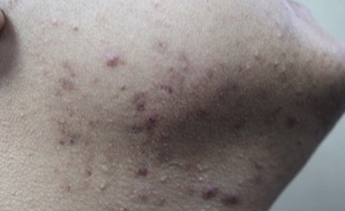 下巴长痘痘是什么原因，下巴长痘痘怎么调理