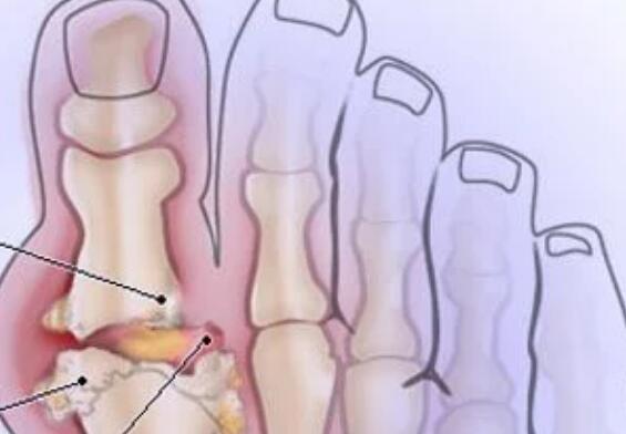 痛风是怎么引起的，请问痛风有什么症状