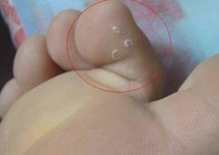 治脚气用什么好，脚气初期图片