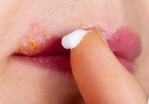 嘴唇上长水泡是什么原因，嘴唇上起水泡怎么办