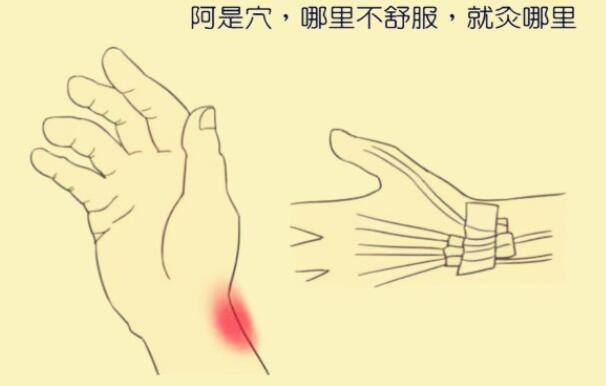 什么是阿是穴，怎么找阿是穴最简单