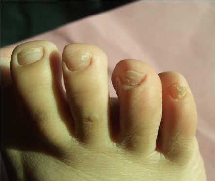 花椒醋大蒜能治灰指甲吗？