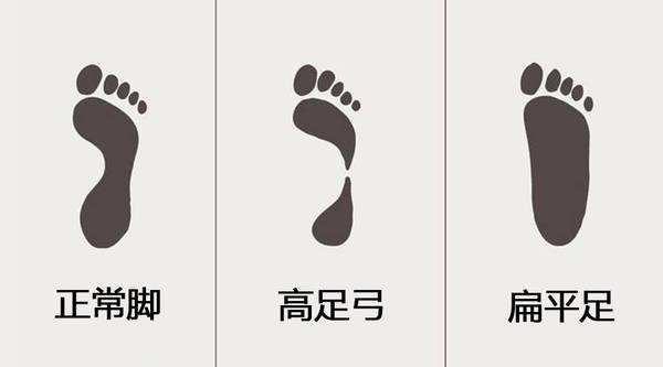 扁平足是什么？扁平足的矫正方法