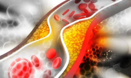 了解血管系统远离血管疾病 让血管恢复青春的保鲜剂