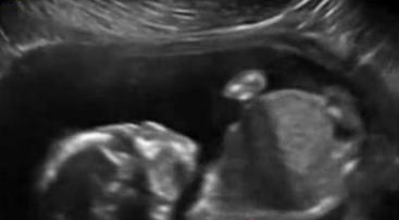 子宫内胎儿自打脸 胎宝宝在孕妇肚中的小动作