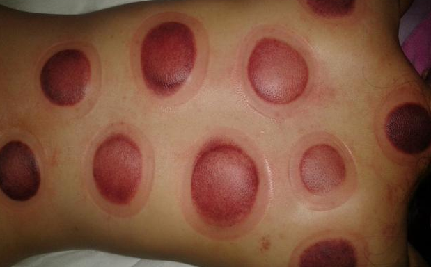 拔罐的好处和坏处，拔罐后湿气重图片