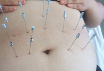 什么是埋线减肥，埋线减肥法的两大禁忌