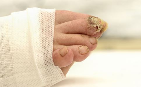 夏季脚臭如何制理 除脚臭最快的好方法