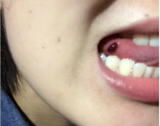 口腔上火以为不是什么大事，医生检查是早期舌癌！