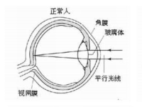 眼睛近视能治疗吗，近视眼恢复小妙招
