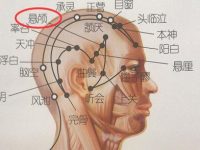 悬颅疼是为什么，悬颅准确位置图和作用