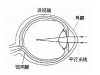 500度近视是几点几(五分制)？