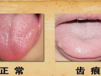 舌苔厚白是怎么回事，舌苔常见的4种表现