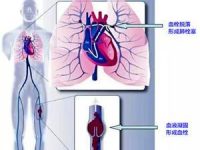 身上青筋凸起要警惕：这是在发出疾病的信号